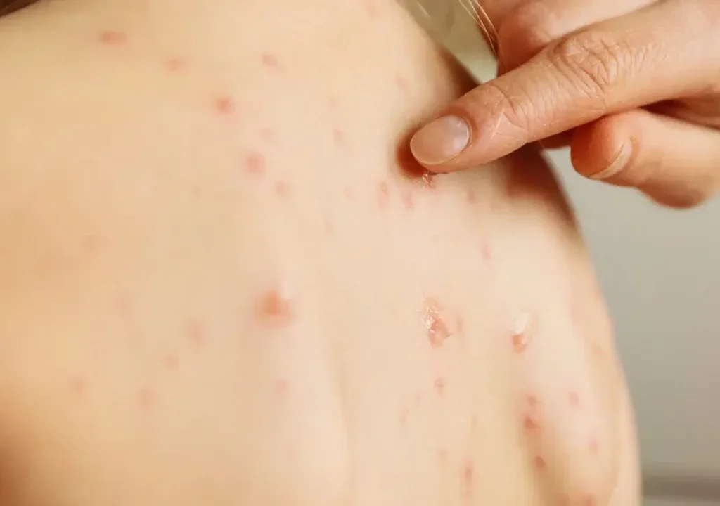 Skin Infections