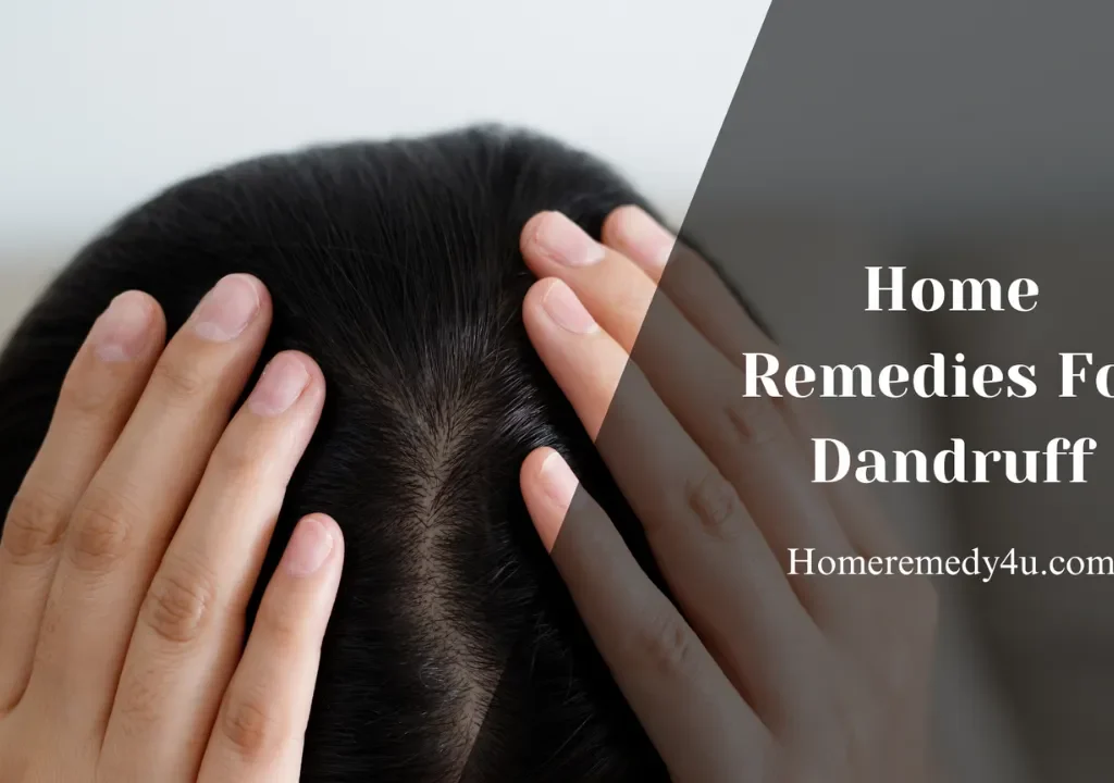 home remedies for Dandruff