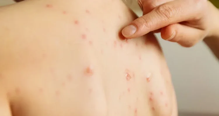 Skin Infections Skin Infections