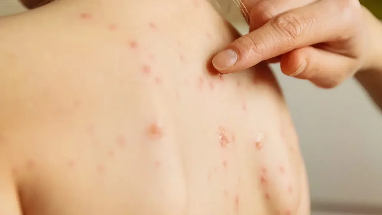 Skin Infections